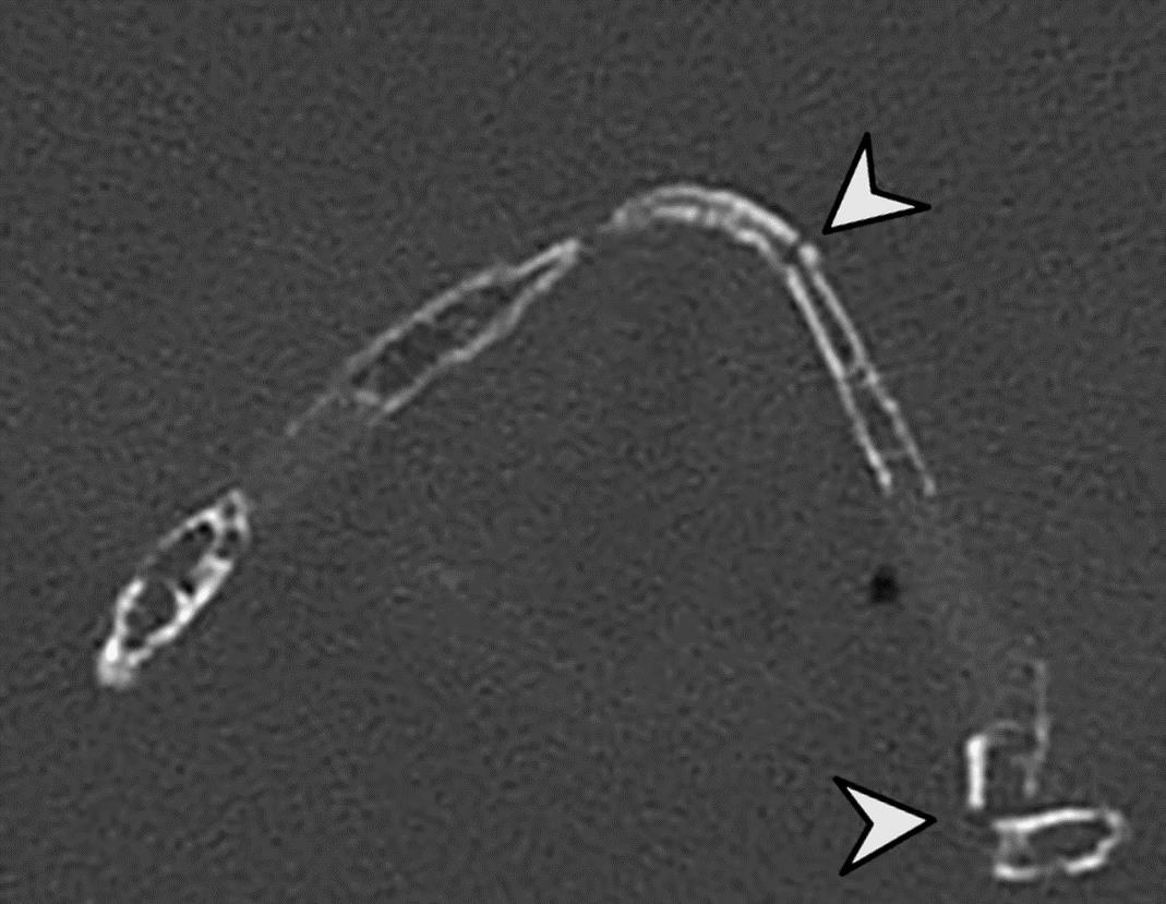 喉頭の死後CT再構成画像、2箇所の骨折
